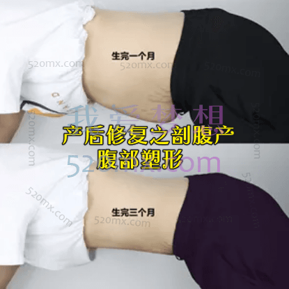 产后修复之剖腹产腹部塑形