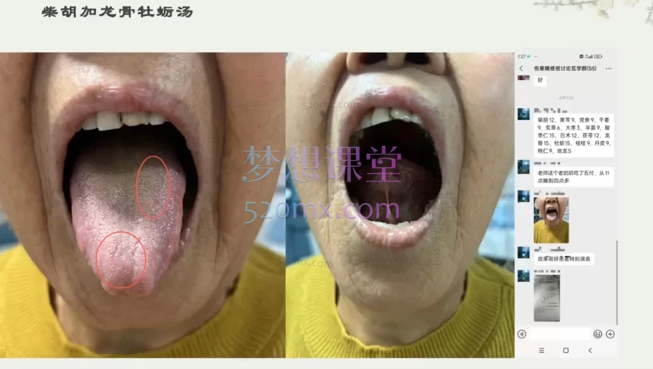 徐辉舌诊精解伤寒(视频+课件)